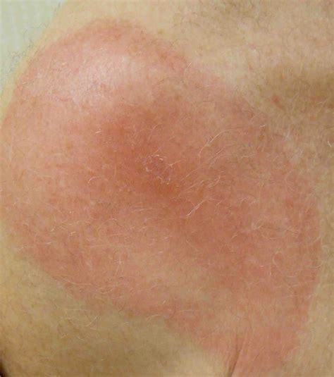 Deep Machine Learning Can More Accurately Identify Erythema Migrans Rashes In Early Lyme Disease