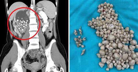 Cirurgiões retiram mais de 300 pedras no rim de jovem 20 anos que não