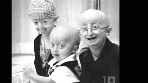 Babies With Progeria Youtube