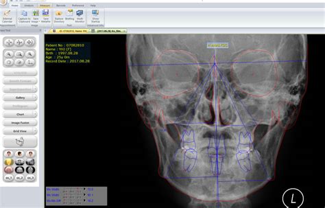 osstem v ceph crack4dental latest dongle crack