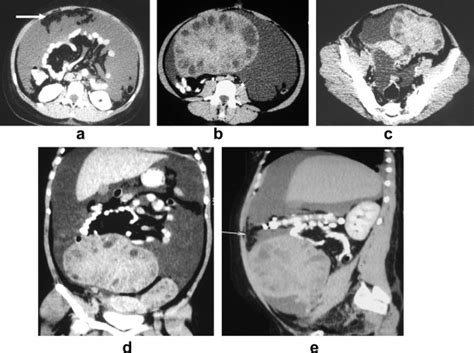 Fifty Six Year Old Woman With Bilateral Ovarian Carcinoma A Axial Ct