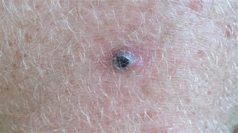 Arm Mole Count May Predict Skin Cancer Risk Sundoctors