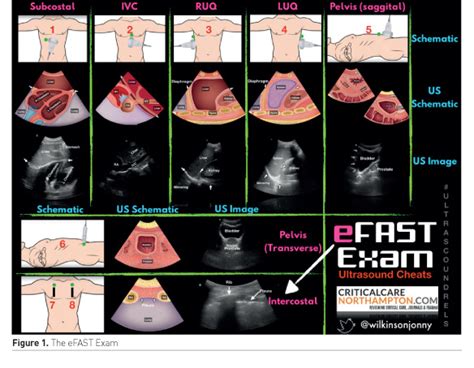 Abdominal Point Of Care Ultrasound In Critical Care