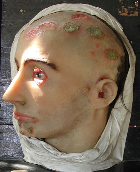 In addition, hiv infection and syphilis are linked. syphilis secondary