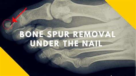 Bone Spur Under Big Toe Nail Subungual Exostosis Youtube