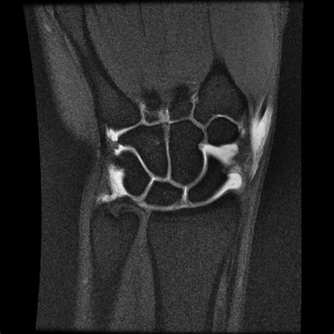 Normal Wrist 3 T Mri Image