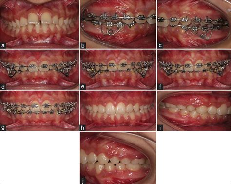 The Double Sided Intrusion Spring Apos Trends In Orthodontics
