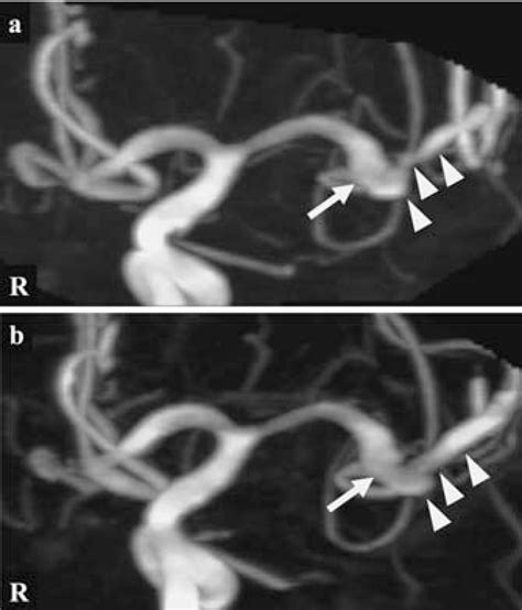 A Hyperdense Artery Sign And Middle Cerebral Artery Dissection