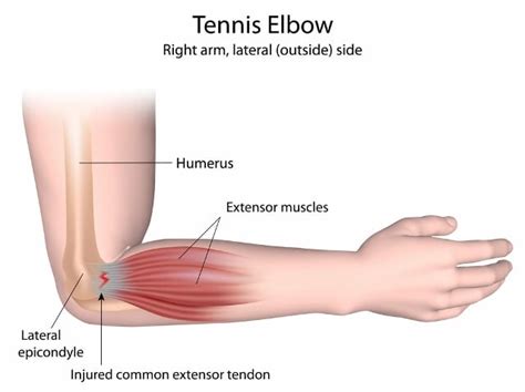 tennis elbow treatment perth my physio sorrento near hillarys