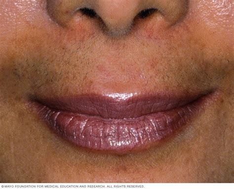 This woman should check with her doctor if she is on medications and is uncertain whether they can cause hair growth. Symptoms and causes - Hirsutism - Mayo Clinic