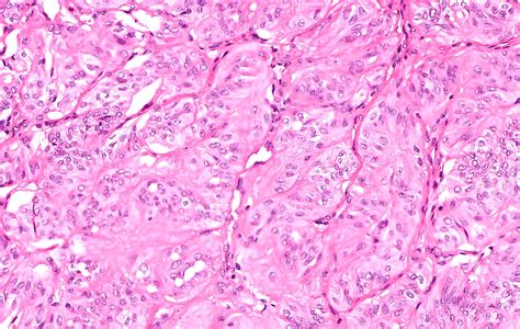 Pathology Outlines Hyalinizing Trabecular Tumor
