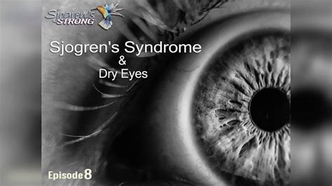 Dry eye syndrome is an eye condition that occurs when the eyes do not produce enough tears or when the tears evaporate too quickly. Sjogren's Syndrome and Dry Eyes - YouTube