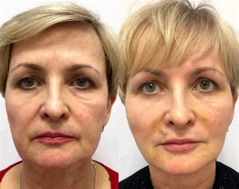Y Lift Facelift Pictures Before And After Facelift Info Prices
