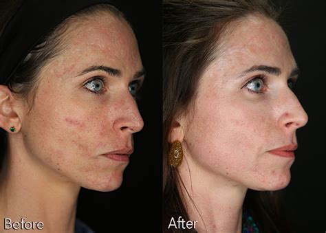 Acne Scar Treatment Before And After Kaado Aesthetics And Anti Aging