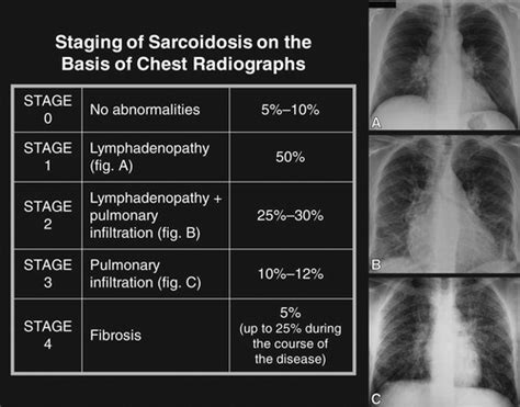 Pulmonary Sarcoidosis Typical And Atypical Manifestations At High