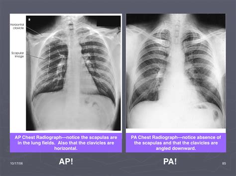 The stomach muscles contract periodically, churning food to enhance digestion. Flashcards - Exam 2-CXR/Abdomen - Chest Position Pros ...