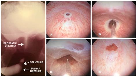 Phẫu thuật tạo hình niệu đạo thành công cho bé trai. Điều trị hẹp niệu đạo (Urethral stricture) | Khám bệnh ở ...