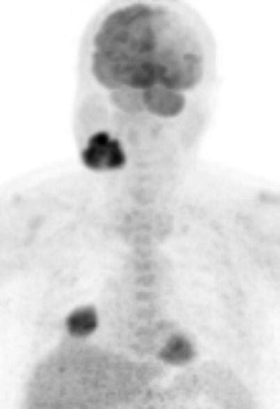 Head And Neck Cancer Radiology Key