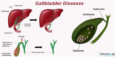 How To Check Gall Bladder Aimsnow7