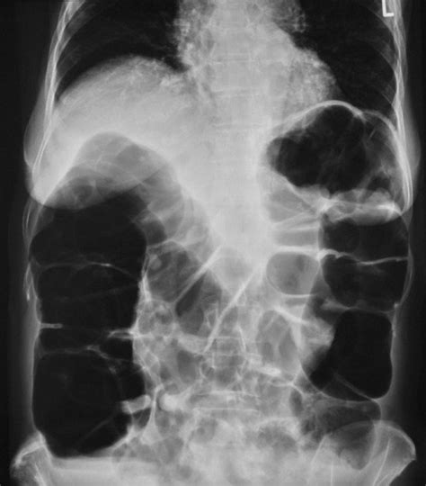 Abdominal X-ray of patient 1 at first presentation. Note ...