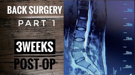 Back Surgery Laminectomy L4 L5 Recovery Part 1 Youtube
