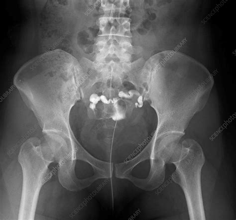 Obstructed Fallopian Tube X Ray Stock Image F Science