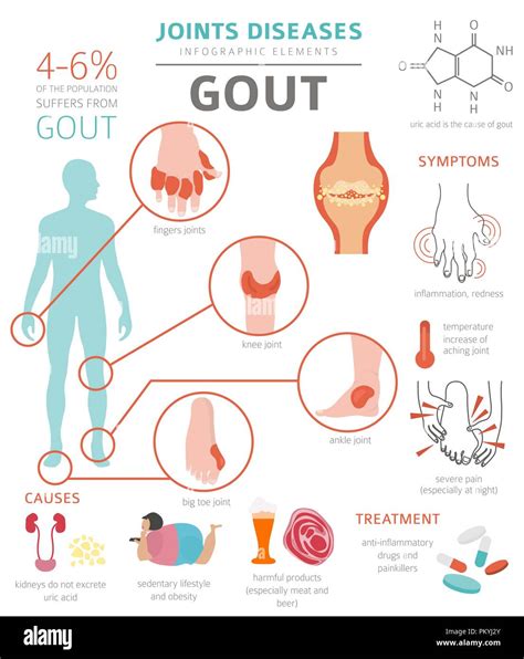 Joints Diseases Gout Symptoms Treatment Icon Set Medical Infographic