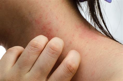 Mimin 29 Eczema Mild Psoriasis On Black Skin