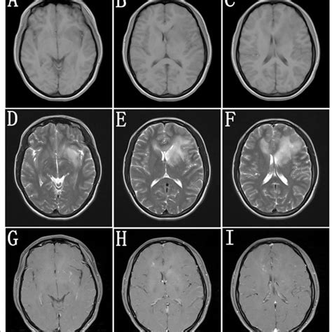 Brain Mri Before Treatments Ten Days After Symptom Onset Brain Mri