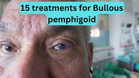 15 Treatments For Bullous Pemphigoid Youtube