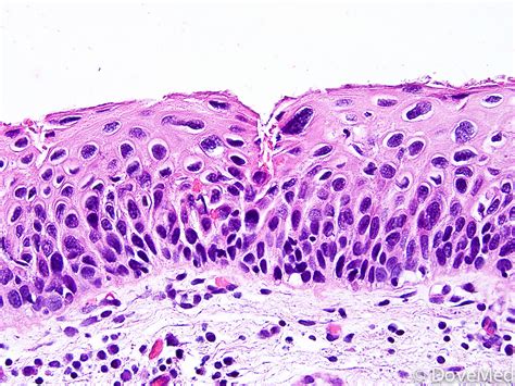 Squamous Cell Carcinoma In Situ Of Penis