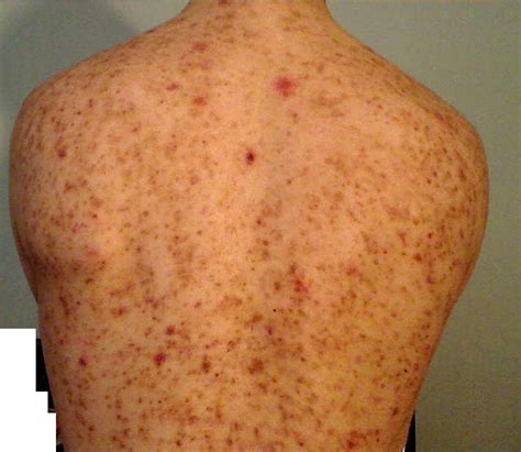 How Do I Get Rid Of My Severe Bacnescars I Had This For Over 4 Years