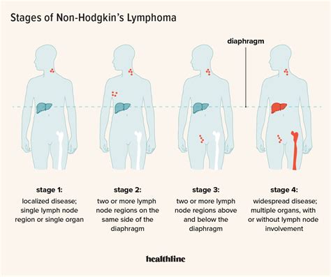 Non Hodgkins Lymphoma Stages Ndependent