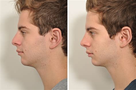 Nose Surgery Before And After Men