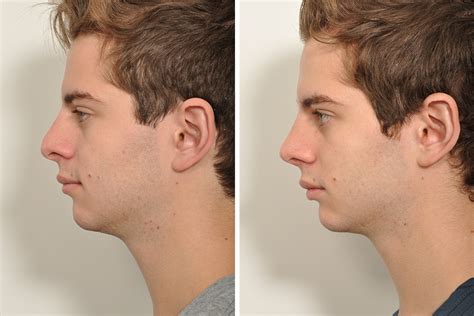 nose surgery before and after men