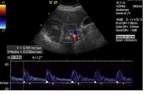 table 1 from doppler ultrasound and renal artery stenosis an overview hot sex picture