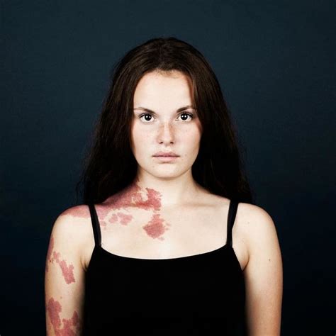 Portraits Of People With Birthmarks That Might Change The Way You