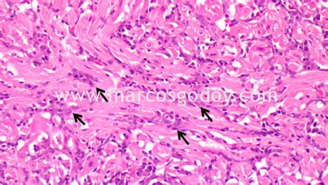 A histologia é uma pericardite crônica inespecífica. Inflamación del Músculo esquelético y cardíaco (HSMI), en ...