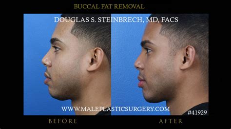 Buccal Fat Removal For Men In Chicago Male Plastic Surgerymale