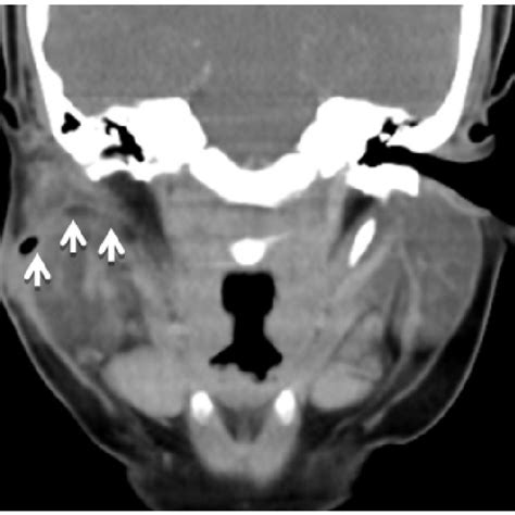 Ct Scan Showing Fistulous Tract Superior To The Right Parotid To The