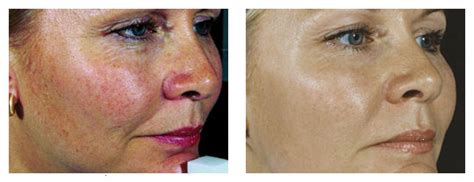 Laser Treatment For Rosacea Melbourne Dermacare Cosmetic And Laser