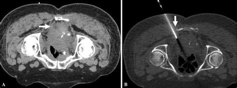 Percutaneous Transgluteal Biopsy Ct Guided Transgluteal Biopsy Was