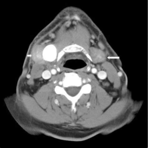 A Ct Scan Of The Neck With Contrast Demonstrating A Large Sialolith Of
