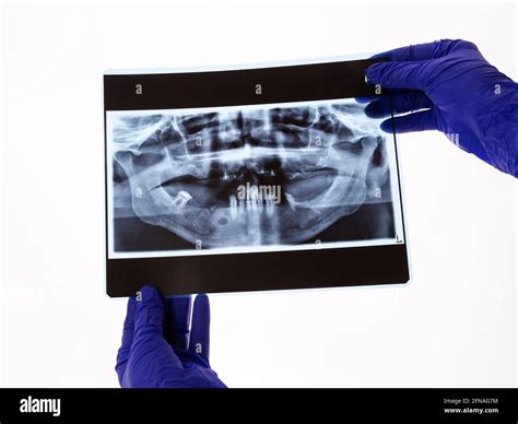 The Dentist Hands Holding The Panoramic Facial X Ray Image Of An Old