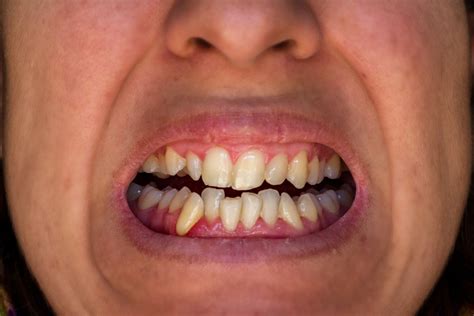 Causes Of Crooked Teeth Shinagawa Orthodontics