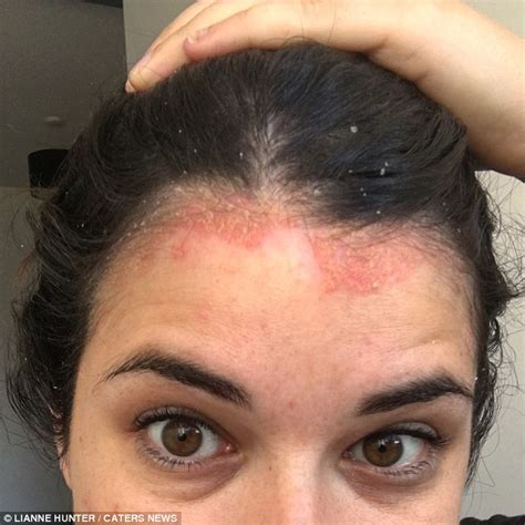 Psoriasis Sufferer Asked To Leave A Swimming Pool Because Of Her Red
