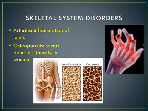 Diseases That Effect Skeletal Anatomy