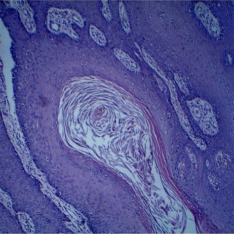Histopathological Appearance Of The Epidermoid Cyst Lined By Stratified