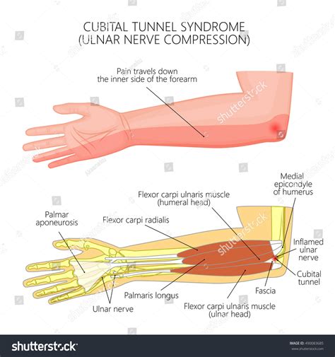 Vector Illustration Cubital Tunnel Syndrome Ulnar Stock Vector Royalty