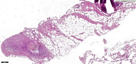 Histology Of Intramuscular Lipoma